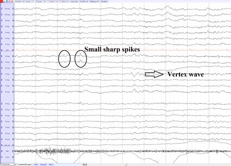 bets eeg|wicket spikes eeg.